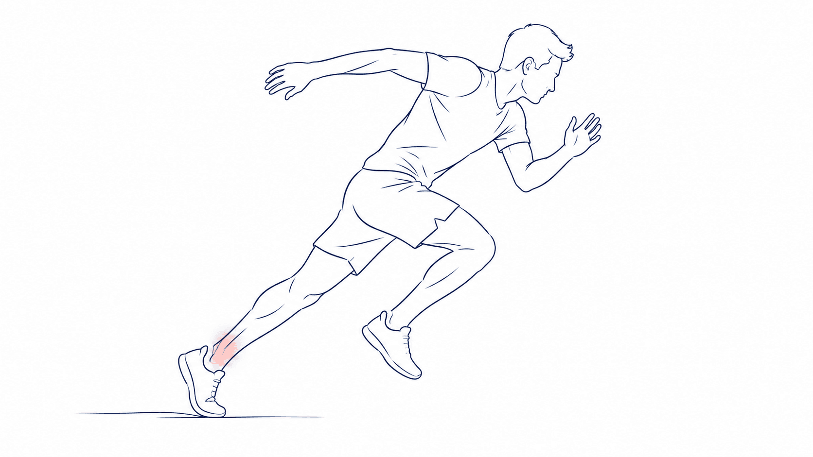 Line illustration of a runner with a highlighted lower-leg injury